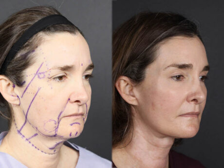 Facelift case #12139