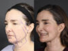 Facelift case #12139 slider thumbnail