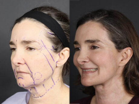 Facelift case #12139