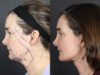 Facelift case #12139 slider thumbnail
