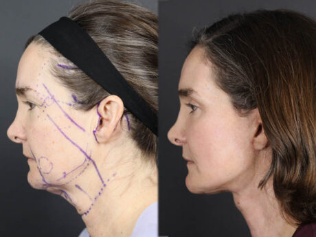 Facelift case #12139