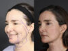 Facelift case #12139 slider thumbnail