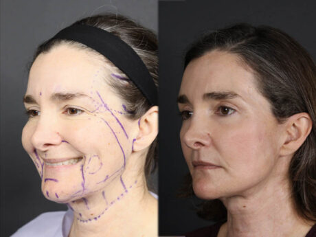 Facelift case #12139