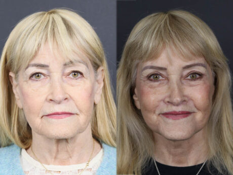 Facelift case #12148