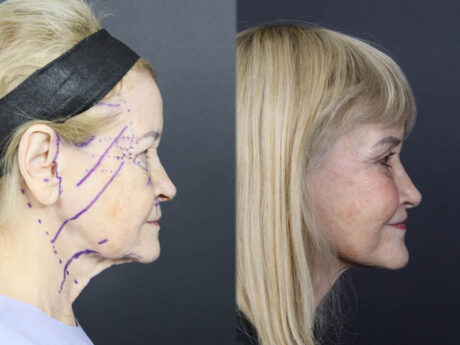 Facelift case #12148