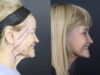 Facelift case #12148 slider thumbnail