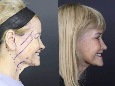 Facelift case #12148