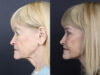 Facelift case #12148 slider thumbnail