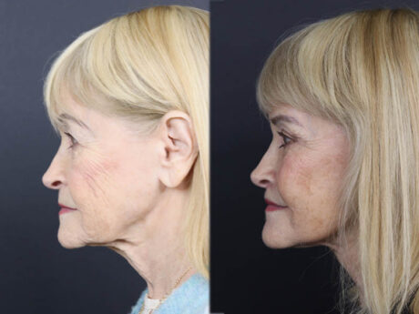 Facelift case #12148