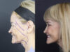 Facelift case #12148 slider thumbnail
