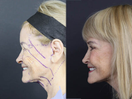 Facelift case #12148