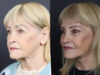Facelift case #12148 slider thumbnail