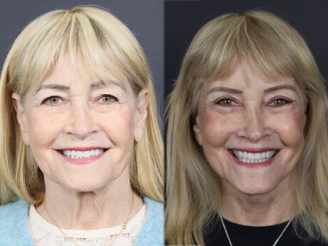 Facelift case #12148