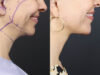 Facelift case #12159 slider thumbnail