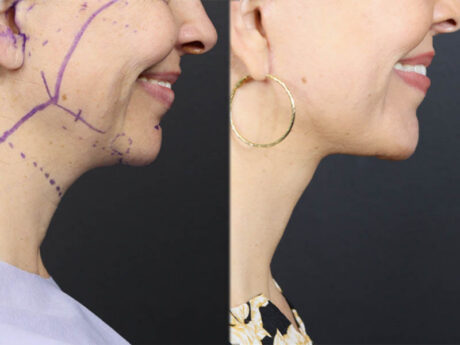 Facelift case #12159