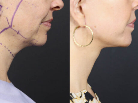 Facelift case #12159