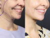 Facelift case #12159 slider thumbnail
