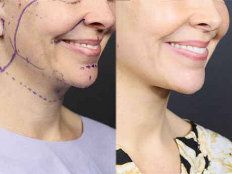 Facelift case #12159
