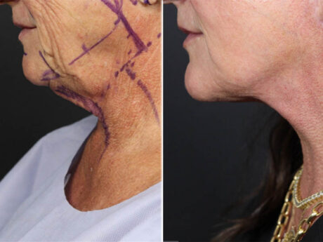 Facelift case #12165