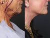 Facelift case #12165 slider thumbnail