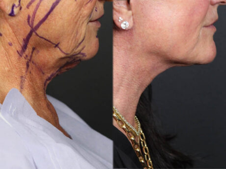 Facelift case #12165