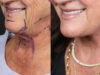 Facelift case #12165 slider thumbnail