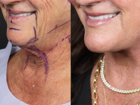 Facelift case #12165