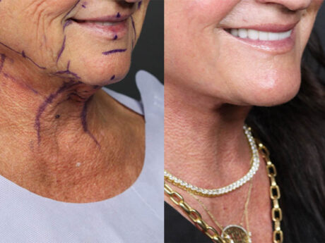 Facelift case #12165