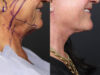 Facelift case #12165 slider thumbnail