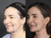 Facelift case #12139 slider thumbnail