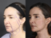 Facelift case #12139 slider thumbnail