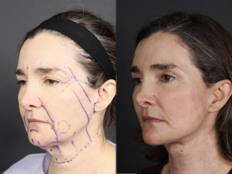 Facelift case #12139