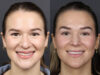 Rhinoplasty case #12553 slider thumbnail