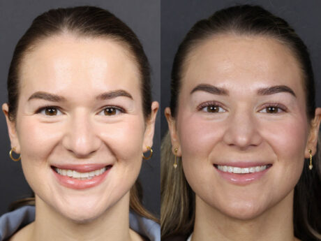 Rhinoplasty case #12553