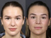 Rhinoplasty case #12553 slider thumbnail