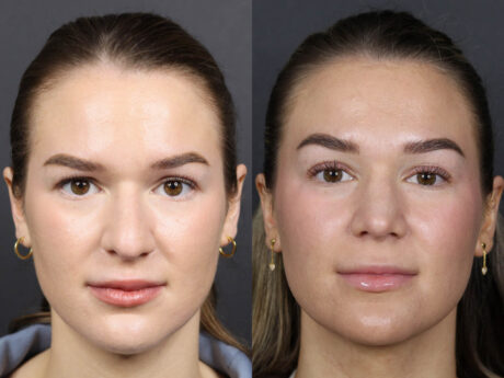 Rhinoplasty case #12553