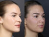 Rhinoplasty case #12553 slider thumbnail