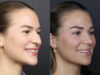 Rhinoplasty case #12553 slider thumbnail