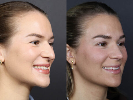 Rhinoplasty case #12553