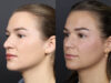 Rhinoplasty case #12553 slider thumbnail