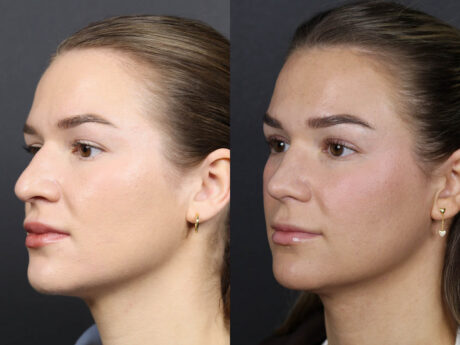 Rhinoplasty case #12553