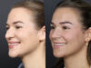 Rhinoplasty case #12553 slider thumbnail