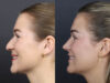 Rhinoplasty case #12553 slider thumbnail