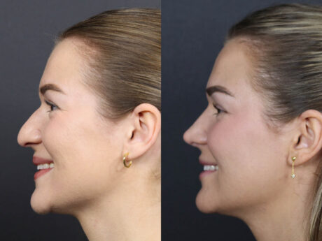 Rhinoplasty case #12553