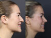 Rhinoplasty case #12553 slider thumbnail