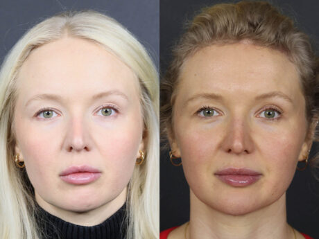 Facial Balancing case #12565