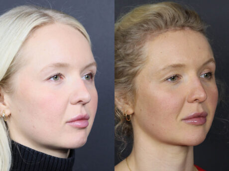 Facial Balancing case #12565