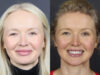 Facial Balancing case #12565 slider thumbnail