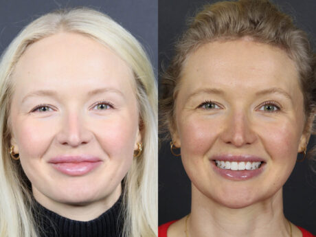 Facial Balancing case #12565