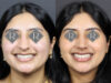 Rhinoplasty case #12571 slider thumbnail